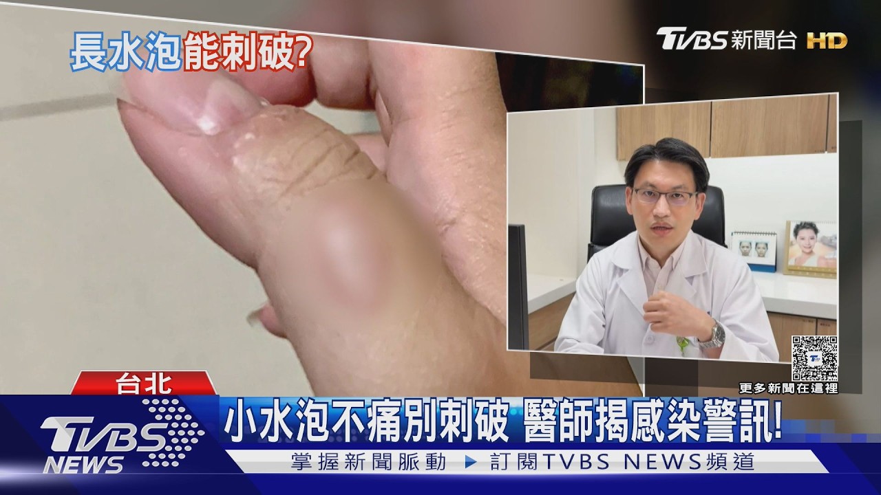 影音/腳底水泡走路痛怎麼辦?醫揭刺破前後 處理重點!