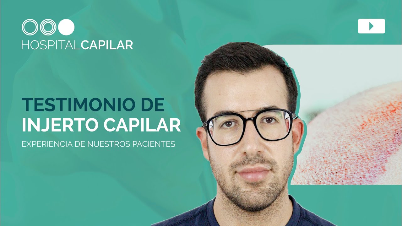 ✨¡TESTIMONIO tras un INJERTO CAPILAR ⎮ La experiencia de nuestros pacientes 📣