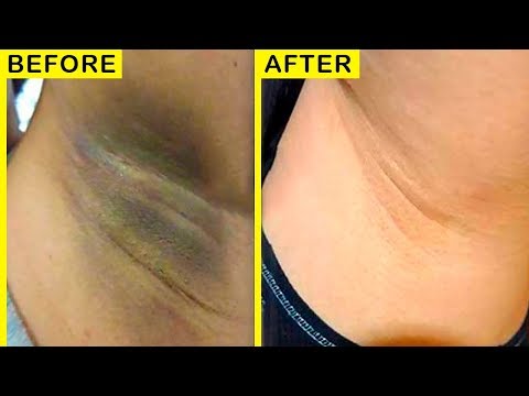 Warum vergilben die Nägel auf den Beinen, wie zu behandeln Gribok auf dem Nagel der Hand die Behandlung vom Jod