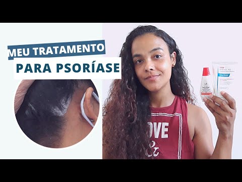 MY TREATMENT FOR PSORIASIS – JUST! SAM