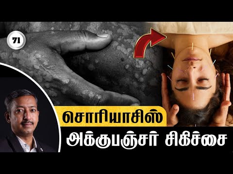 சொரியாசிஸ் தோல் நோய்க்கு அக்குபஞ்சர் சிகிச்சை / Dry Psoriasis / Care To Cure