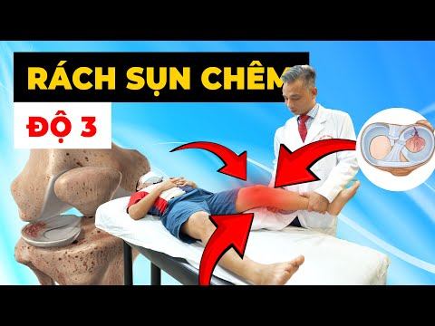 Tổn Thương Sụn Chêm Trong Độ 3: Đau Đớn Tột Cùng & Giải Pháp Điều Trị 