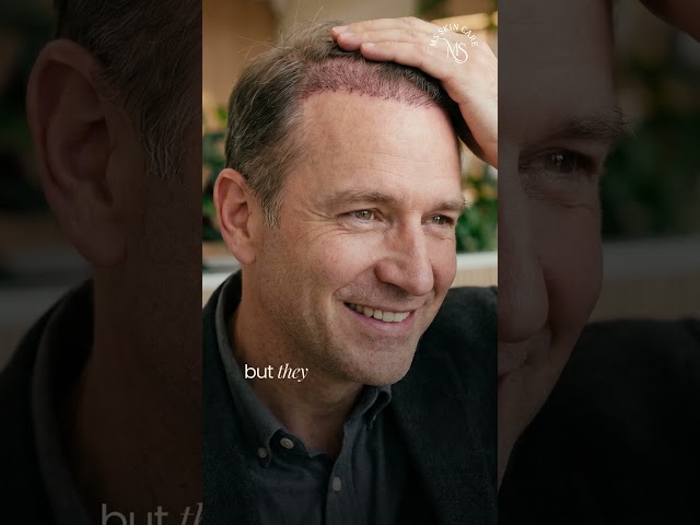 Hair Transplant Delhi
