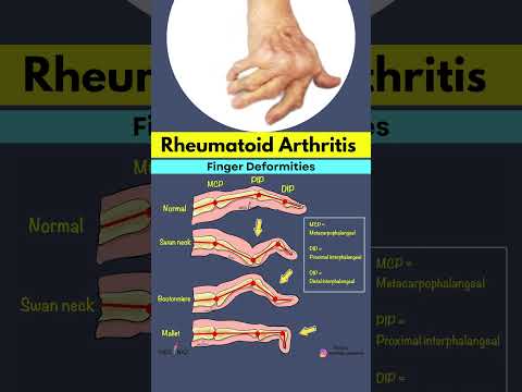 Rheumatoid Arthritis Finger Deformities Explained | Swan Neck, Boutonniere & Mallet Finger