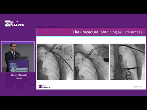 Redefining standards: TAVI in the era of lifetime management, beyond high-risk patients