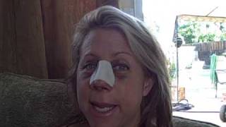 Dr. Nassif Did My New Nose: Day 4