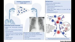 Trends in Mortality of Pneumocystis Pneumonia