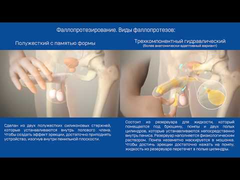 УВЕЛИЧЕНИЕ ПОЛОВОГО ЧЛЕНА