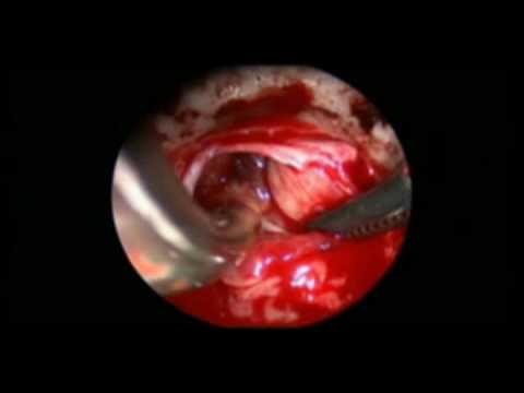 Adenoma Of Hypophysis, Endonasal Endoscopy