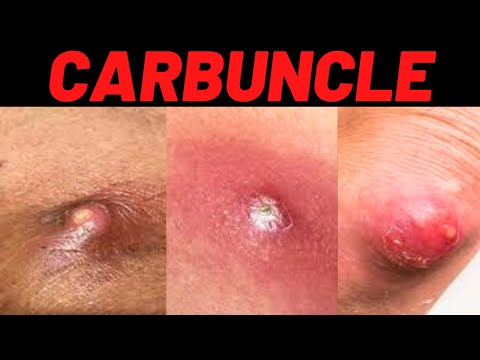 What is Carbuncle? Carbuncle Definition, Symptoms, Causes, Treatment, USMLE