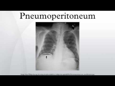 Pneumoperitoneum