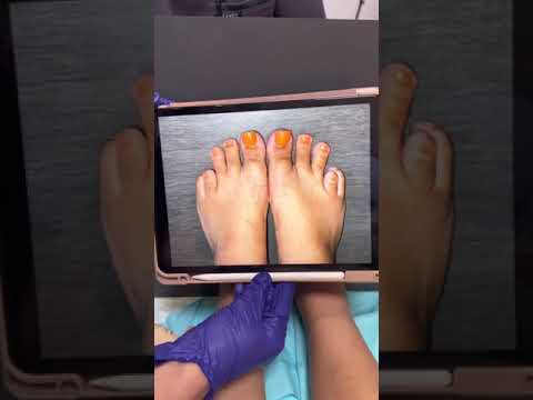 This Toe Transformation is SO Shocking You Won't Believe It!