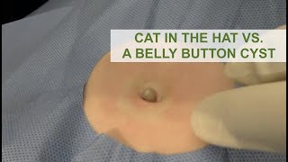 Cat in the Hat vs. A Belly Button Cyst | Dr. Derm