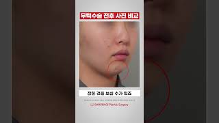이부성형술 성형 시술