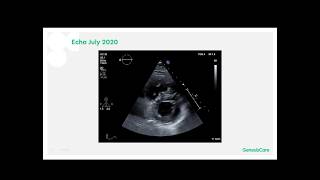 July 2020 Carcinoid Heart Disease secondary to Neuroendocrine Tumors (NET)