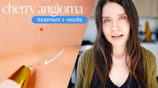 How to Get Rid of Cherry Angiomas (Red Skin Dots) | PLASMA PEN REMOVAL REVIEW + DEMO + RESULTS