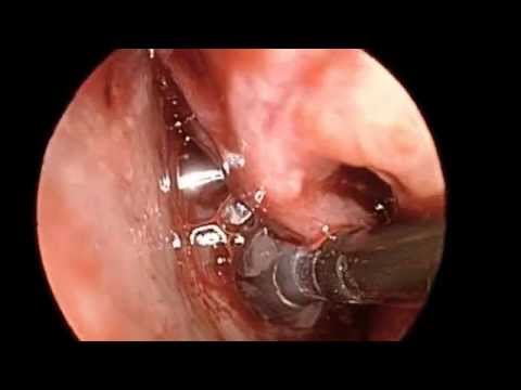 Polypectomy and Transilluminating of Sphenoid Sinus