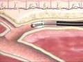 Varicose Veins Closure Procedure At BIDMC