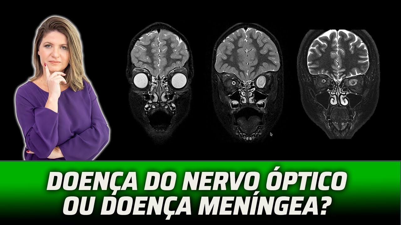 NERVOS ÓPTICOS: MUITO ALÉM DA NEURITE ÓPTICA