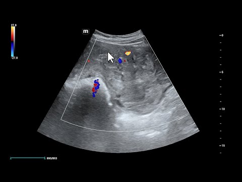 Balão obstétrico / balão de Bakri no sangramento pós parto. Achados ultrassonográficos.