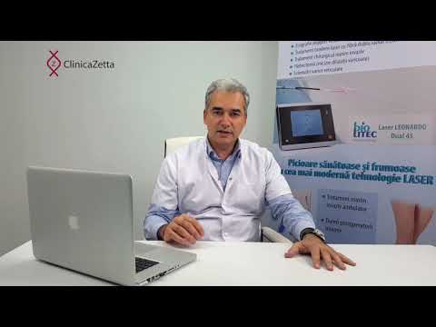 creilin cu vene varicoase varicoza diagnosticului membrelor inferioare
