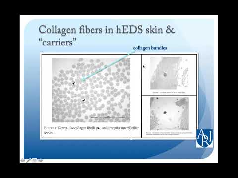 Hypermobility Spectrum Disorders in Families with Autism