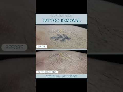 Safe & Effective Laser Tattoo Removal | Real Patient Results