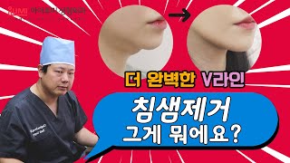 이중턱흡입근육묶기 후 침샘보톡스 or 침샘제거 어떻게?