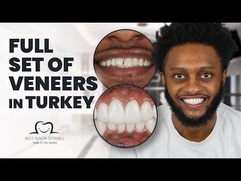 Get Your Teeth Ready for Summer: The Unbeatable Full Set of Veneers in Turkey