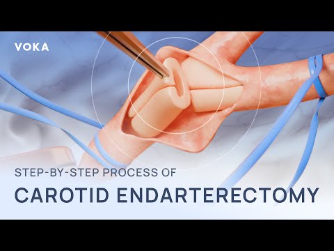 Carotid endarterectomy medical animation: from plaque removal to restored blood flow
