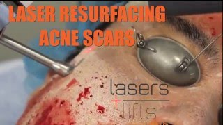 LASER RESURFACING ACNE SCARS- with 2 lasers in the one session