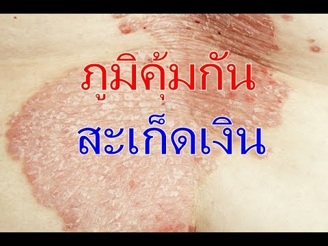 การรักษาโลชั่นของโรคสะเก็ดเงิน สาเหตุของโรคกลาก