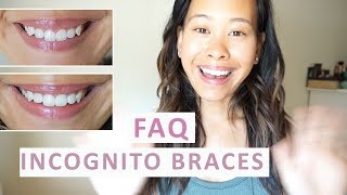 Incognito Lingual Braces FAQ | Everything You Need to Know