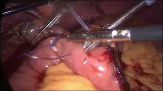 Asvide: Pancreaticojejunostomy with modified stent tube.