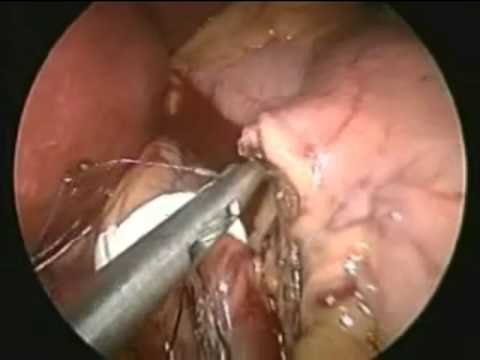 Laparoscopic Ring Gastric Bypass Surgery