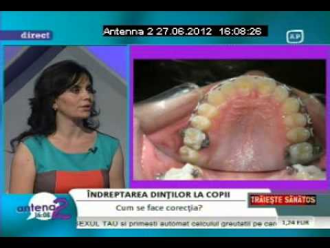 Dr. EMILIA MILICIN – Antena2 – Metode de îndreptare a dinților la copii 27-06-2012