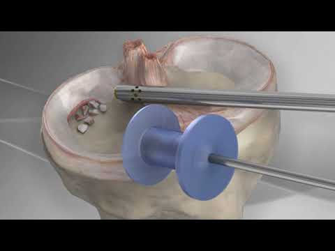 Artroskopowe usunięcie łąkotki - meniscektomia