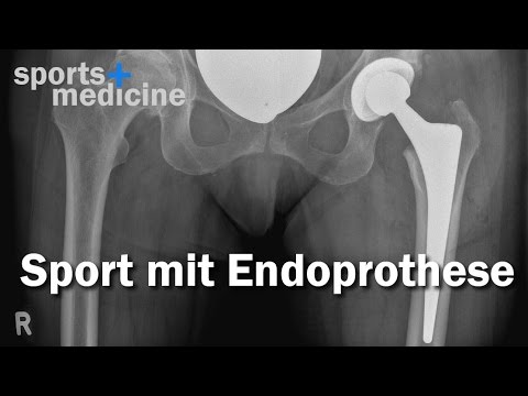 Sport mit künstlichem Gelenk - was darf ich nach der OP noch machen?
