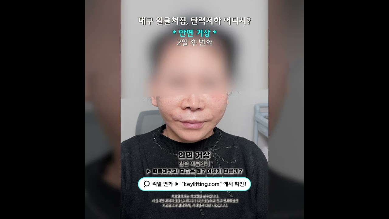 60대 안면거상술 2일후 변화모습