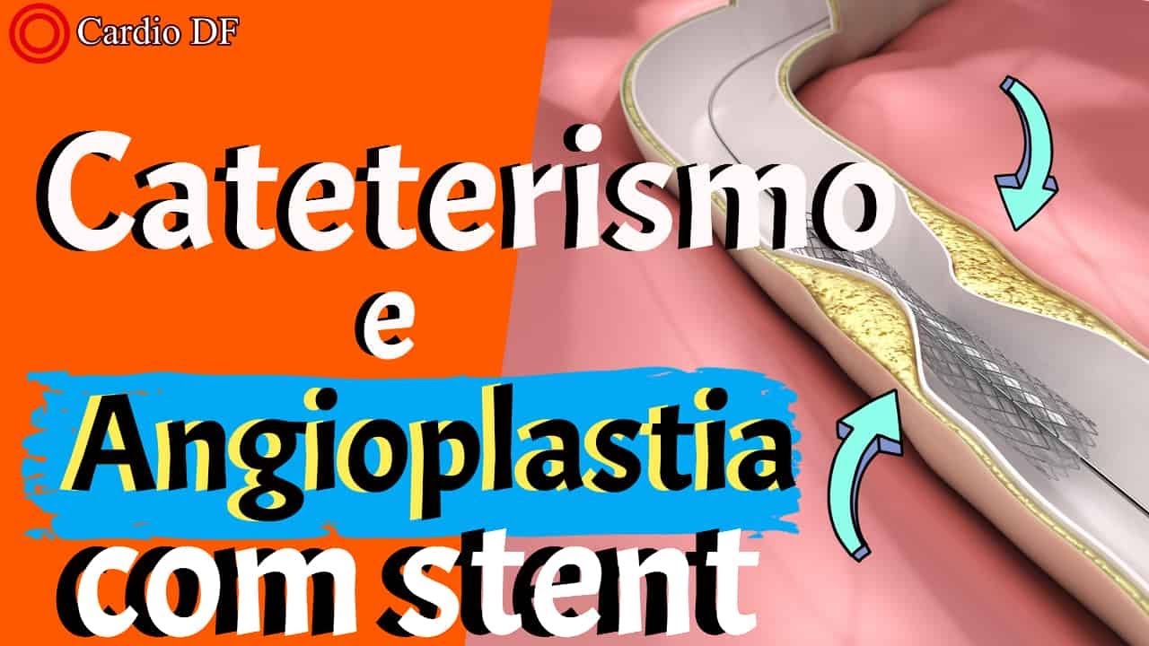 CATETERISMO e ANGIOPLASTIA COM STENT: saiba tudo (2021)