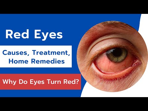 Red Eyes: Causes, Treatment and Home Remedies | Effective Home Remedies For Red Eyes