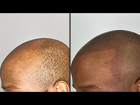 Hvad koster en SMP-behandling? (Hårtab)