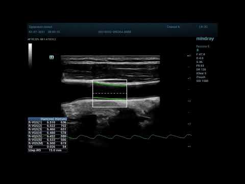 R -VQS (Radiofrequency Vascular Stiffness Quantification) R -VQS (Radiofrequency Vascular Stiffness Quantification)