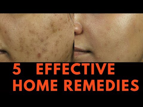 5 EFFECTIVE Home Remedies for Skin Pigmentation, Brown...