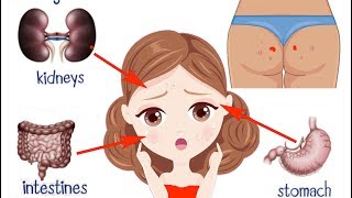 16 Acne Locations and What They Reveal About Your Health - Acne Meaning & Face Mapping Your Pimple