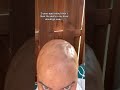 Not so good side effects of treatment #inspiring #selflove #alopecia #hairlosstreatment