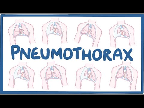 Pneumothorax - causes, symptoms, diagnosis, treatment, pathology