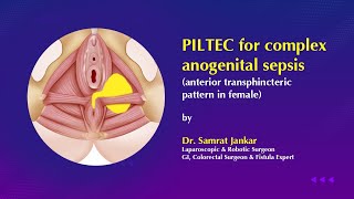 PILTEC Surgery for Complex Anal Fistula in Female | Dr. Samrat Jankar | Full Recovery Case Explained