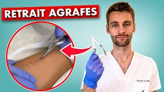 Ablation d'agrafes chirurgicales sans erreur - soin infirmier