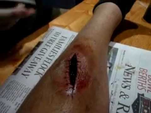 download lagu mp3 mp4 Hemotoma, download lagu Hemotoma gratis, unduh video klip Download Hemotoma Mp3 dan Mp4 Viral Gratis